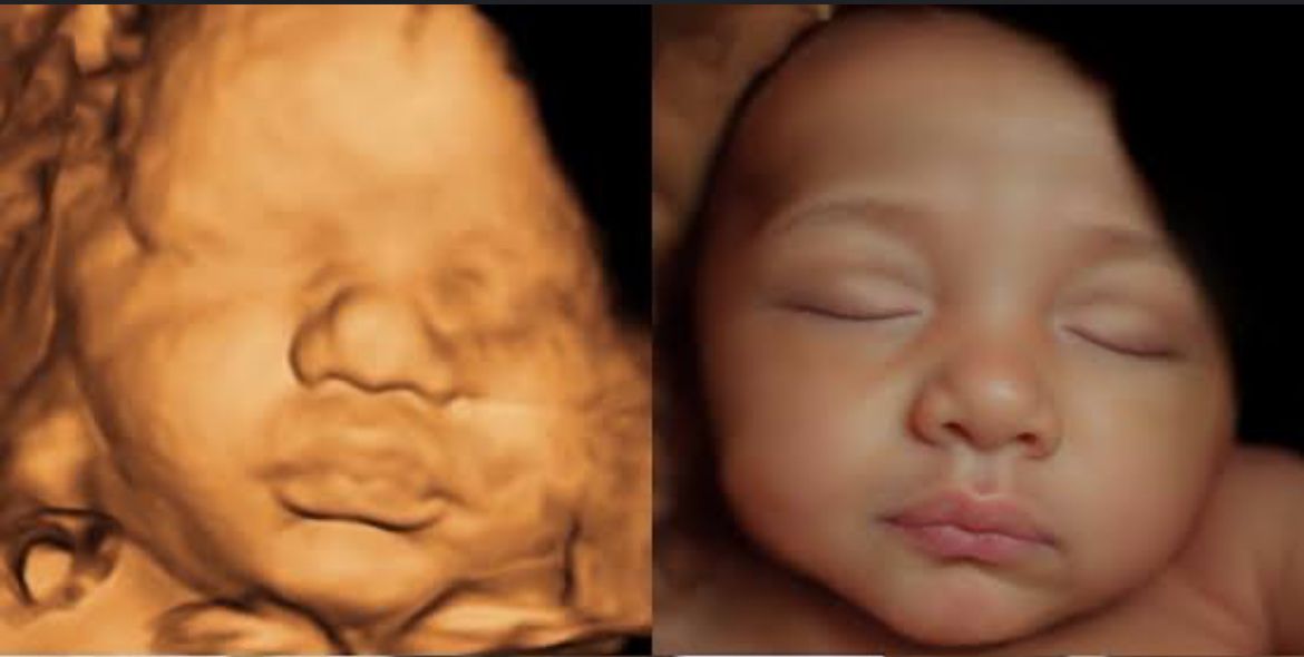 Comparativo de ultrassom e projeção do bebê